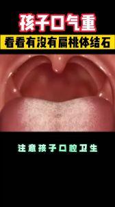 扁桃体视频,视频带你了解扁桃体结构与功能